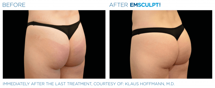 EMSCULPT NEO Before and After | Navarre Wellness