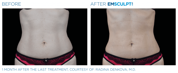 EMSCULPT NEO Before and After | Navarre Wellness
