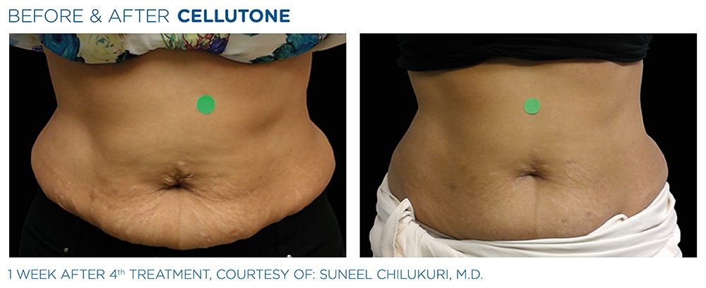 Cellutone before & after | Navarre Wellness