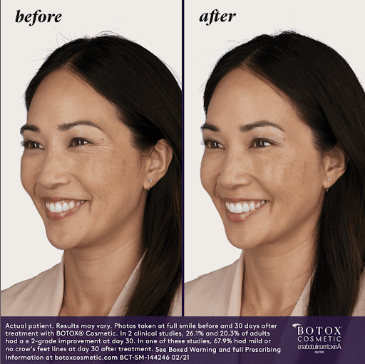 BOTOX before & after | Navarre Wellness