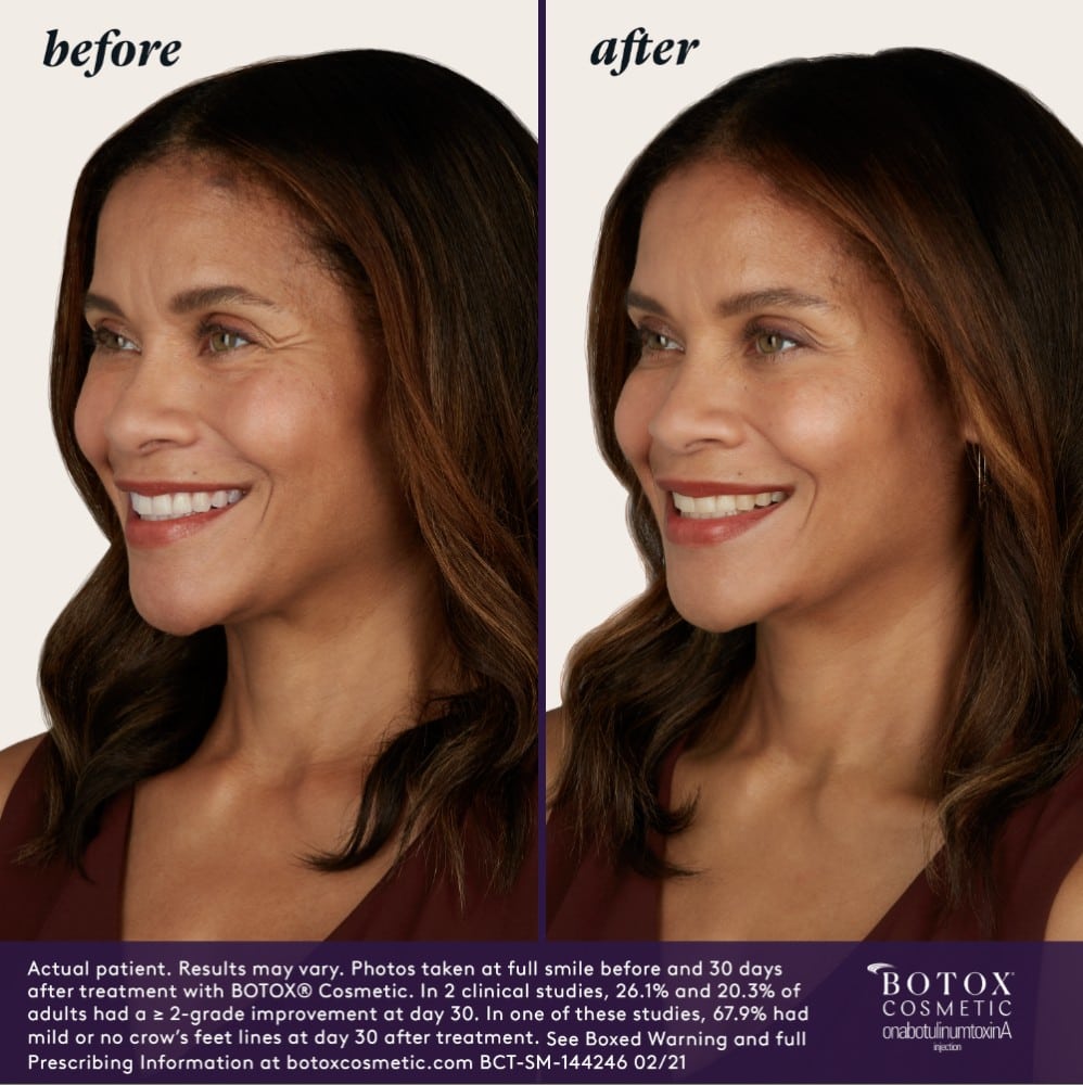woman’s face before and after BOTOX injections, fewer lines after treatment