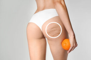 CELLUTONE and Cellulite
